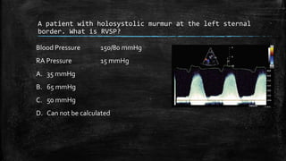 A patient with holosystolic murmur at the left sternal
border. What is RVSP?
Blood Pressure 150/80 mmHg
RA Pressure 15 mmHg
A. 35 mmHg
B. 65 mmHg
C. 50 mmHg
D. Can not be calculated
 