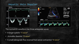 Hepatic Vein Doppler
The normal HV waveform has three antegrade waves
▪ A larger systolic “S wave”
▪ A smaller diastolic “D wave”
▪ A small retrograde flow reversal from atrial contraction “A wave”
 