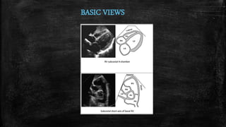 Right Heart Dimensions
▪ Right ventricle-focused apical 4 chamber view
– Measured at end-diastole
 