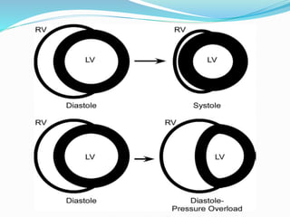 Dsign Rv Failure Acute RV Failure in ARDS | PPTX