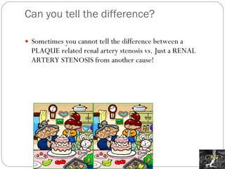 Can you tell the difference? Sometimes you cannot tell the difference between a PLAQUE related renal artery stenosis vs. Just a RENAL ARTERY STENOSIS from another cause! 