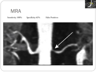 MRA Sensitivity 100%  Specificity 65% False Positives 