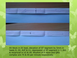 AV block in III lead, elevation of ST segment by 5mm in
leads II, III, AVF & V1, depression of ST segment in I, AVL
& reciprocal in V2 & V6. Rhythm of P wave and QRS
complex are 75 & 45 per minute respectively.
 