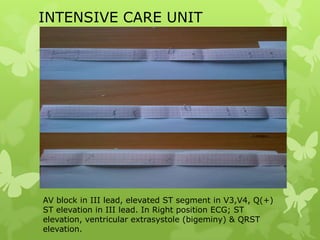 INTENSIVE CARE UNIT
AV block in III lead, elevated ST segment in V3,V4, Q(+)
ST elevation in III lead. In Right position ECG; ST
elevation, ventricular extrasystole (bigeminy) & QRST
elevation.
 