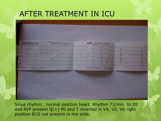 AFTER TREATMENT IN ICU
Sinus rhythm , normal position heart. Rhythm 71/min. In III
and AVF present Q(+) MI and T inverted in V4, V5, V6 right
position ECG not present in the slide.
 
