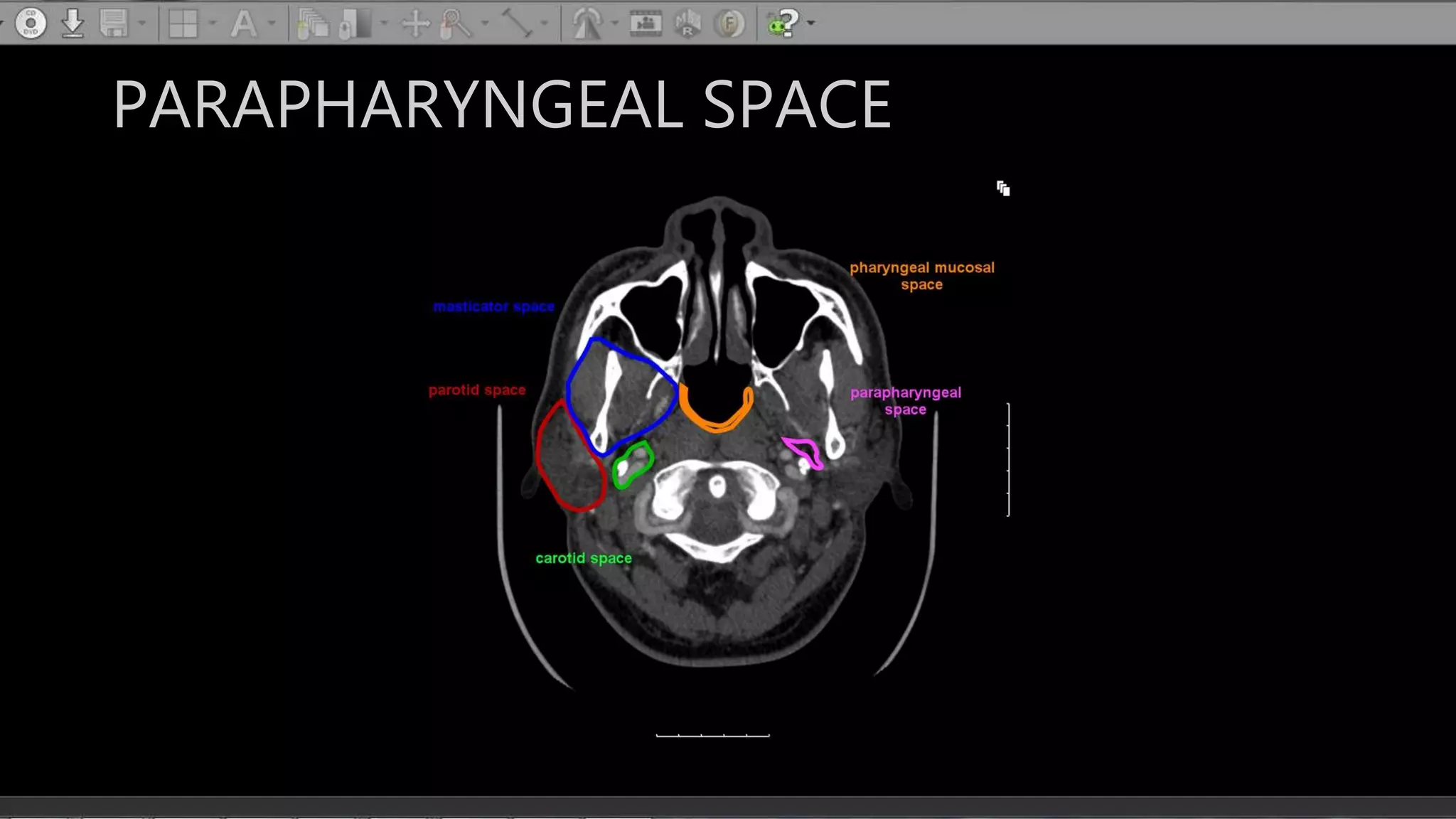 PARAPHARYNGEAL SPACE
 
