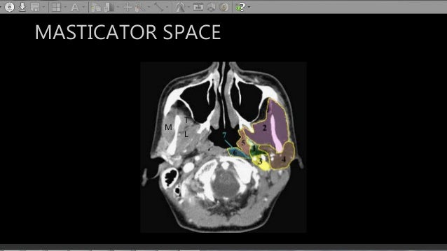 CT anatomy of Neck Spaces RV
