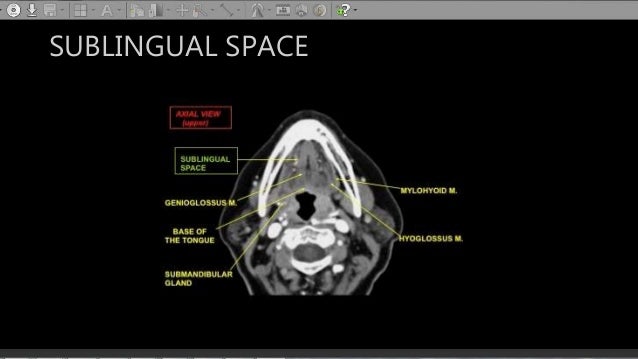 The Mandible A Ring Bone The Mandible A Ring Bone