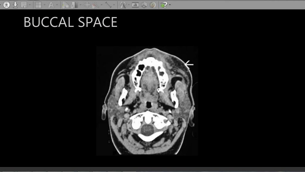 CT anatomy of Neck Spaces RV