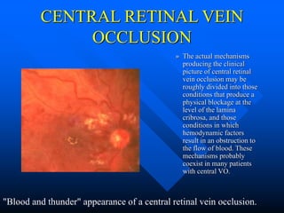 Rvo rvo.ppt retinal vein occlusion reti00nal | PPT