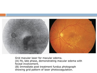 Grid macular laser for macular edema.
(A) FA, late phase, demonstrating macular edema with
foveal involvement.
(B) Immediate post treatment fundus photograph
showing grid pattern of laser photocoagulation.
 