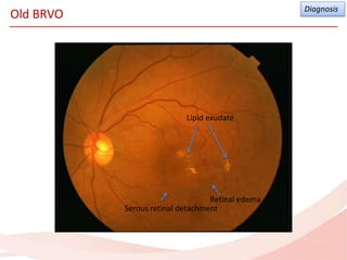 RVO risk factors and management pearls | PPTX
