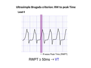 Ultrasimple Brugada criterion: RW to peak Time
 