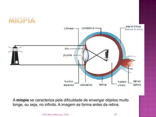 A miopia se caracteriza pela dificuldade de enxergar objetos muito
longe, ou seja, no infinito. A imagem se forma antes da retina.

                Prof. Mario Mancuso - RVS                78
 