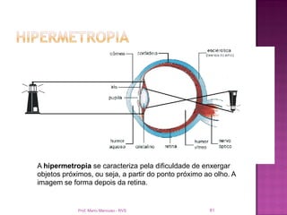 A hipermetropia se caracteriza pela dificuldade de enxergar
objetos próximos, ou seja, a partir do ponto próximo ao olho. A
imagem se forma depois da retina.


            Prof. Mario Mancuso - RVS                 81
 