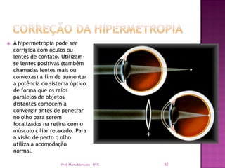    A hipermetropia pode ser
    corrigida com óculos ou
    lentes de contato. Utilizam-
    se lentes positivas (também
    chamadas lentes mais ou
    convexas) a fim de aumentar
    a potência do sistema óptico
    de forma que os raios
    paralelos de objetos
    distantes comecem a
    convergir antes de penetrar
    no olho para serem
    focalizados na retina com o
    músculo ciliar relaxado. Para
    a visão de perto o olho
    utiliza a acomodação
    normal.

                      Prof. Mario Mancuso - RVS   82
 