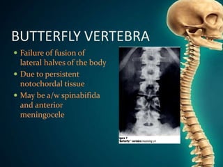 Congenital Anomalies Of Spine And Spinal Cord | PPTX