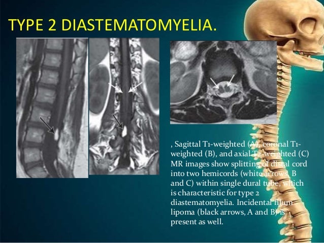 Congenital Anomalies Of Spine And Spinal Cord