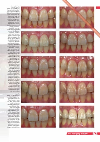 Abb. 67 bis 75
                           67   68
Nein, es handelt sich
 hierbei nicht um Stu-
dien unterschiedlicher
Zähne. So verblüffend
 es ist, aber diese Bil-
  derstrecke zeigt ein
 und dieselbe Mund-
situation, aufgenom-
   men mit neun Digi-
 talkameras von fünf
   Namhaften Firmen
(Aufnahmedatum und
     Uhrzeit variieren).
    Natürlich wird der
 Farbunterschied nicht
  nur von der Digital-
      kamera, sondern      69   70
   auch vom verwen-
  deten Objektiv und
   Blitz verursacht. Da
 ich mit diesen Bildern
 den Einfluss der Ka-
    mera und des ent-
 sprechenden Makro-
   objektivs darstellen
wollte, habe ich immer
    denselben Zangen-
  blitz verwendet. Bei
allen Geräten wurde
       der Blitz-Modus
  (Weißabgleich), der
     Aufnahme-Modus
  auf Manuell und die
     Verschlusszeit auf    71   72
 1/125 eingestellt. Die
     Blende wurde bei
  jedem Gerät unter-
     schiedlich, für das
     Dateiformat aber
        einheitlich JPEG
     gewählt. ISO war
     auf die niedrigste
   Empfindlichkeit ge-
   stellt und die Farb-
 einstellung stand auf
  Maximum. Eine ein-
   heitliche Belichtung
  lies ich mir vor dem
  Auslösen vom Histo-
   gramm bestätigen.       73   74
     Somit werden die
      unterschiedlichen
  „Farbkonzepte“ der
   einzelnen Kameras
   und Hersteller bes-
        ser verständlich

               Abb. 76
Nicht nur die Kamera
und das Objektiv ha-
 ben Einfluss auf das
  Foto, sondern auch
der Blitz. Dieses Foto
     wurde mit einem
Ringblitz aufgenom-
   men. Da das Blitz-
      licht vom Objekt     75   76
   direkt auf das Ob-
jektiv reflektiert wird,
     hat das zu Folge,
 dass die reflektierte
Fläche auf dem Ob-
 jekt größer ist. Diese
   Methode ist daher
gut geeignet, um die
Oberflächenbeschaf-
  fung auszuleuchten
  oder den Molaren-
  bereich oder Zahn-
bögen aufzunehmen




                                     03. Jahrgang 3/2009   63
 