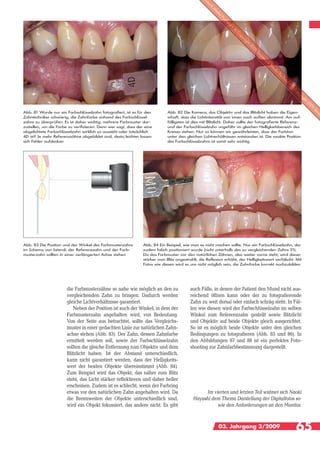 Abb. 81 Wurde nur ein Farbschlüsselzahn fotografiert, ist es für den         Abb. 82 Die Kamera, das Objektiv und das Blitzlicht haben die Eigen-
Zahntechniker schwierig, die Zahnfarbe anhand des Farbschlüssel-             schaft, dass die Lichtintensität von innen nach außen abnimmt. Am auf-
zahns zu überprüfen. Es ist daher wichtig, mehrere Farbmuster dar-           fälligsten ist dies mit Blitzlicht. Daher sollte der fotografierte Referenz-
zustellen, um die Farbe zu verifizieren. Denn wer sagt, dass der eine        und der Farbschlüsselzahn ungefähr im gleichen Helligkeitsbereich des
abgelichtete Farbschlüsselzahn wirklich so aussieht oder tatsächlich         Kreises stehen. Nur so können wir gewährleisten, dass der Farbton
4D ist? Je mehr Referenzzähne abgebildet sind, desto leichter lassen         unter den gleichen Lichtverhältnissen entstanden ist. Die exakte Position
sich Fehler aufdecken                                                        des Farbschlüsselzahns ist somit sehr wichtig




Abb. 83 Die Position und der Winkel des Farbmusterzahns         Abb. 84 Ein Beispiel, wie man es nicht machen sollte. Nur ein Farbschlüsselzahn, der
im Schema von lateral: der Referenzzahn und der Farb-           zudem falsch positioniert wurde (nicht unterhalb des zu vergleichenden Zahns 21).
musterzahn sollten in einer verlängerten Achse stehen           Da das Farbmuster vor den natürlichen Zähnen, also weiter vorne steht, wird dieser
                                                                stärker vom Blitz angestrahlt, die Reflexion erhöht, der Helligkeitswert verfälscht. Mit
                                                                Fotos wie diesen wird es uns nicht möglich sein, die Zahnfarbe korrekt nachzubilden




                       die Farbmusterzähne so nahe wie möglich an den zu                  auch Fälle, in denen der Patient den Mund nicht aus-
                       vergleichenden Zahn zu bringen. Dadurch werden                     reichend öffnen kann oder der zu fotografierende
                       gleiche Lichtverhältnisse garantiert.                              Zahn zu weit dorsal oder einfach schräg steht. In Fäl-
                          Neben der Position ist auch der Winkel, in dem der              len wie diesen wird der Farbschlüsselzahn im selben
                       Farbmusterzahn angehalten wird, von Bedeutung.                     Winkel zum Referenzzahn gestellt sowie Blitzlicht
                       Von der Seite aus betrachtet, sollte das Vergleichs-               und Objektiv auf beide Objekte gleich ausgerichtet.
                       muster in einer gedachten Linie zur natürlichen Zahn-              So ist es möglich beide Objekte unter den gleichen
                       achse stehen (Abb. 83). Der Zahn, dessen Zahnfarbe                 Bedingungen zu fotografieren (Abb. 85 und 86). In
                       ermittelt werden soll, sowie der Farbschlüsselzahn                 den Abbildungen 87 und 88 ist ein perfektes Foto-
                       sollten die gleiche Entfernung zum Objektiv und dem                shooting zur Zahnfarbbestimmung dargestellt.
                       Blitzlicht haben. Ist der Abstand unterschiedlich,
                       kann nicht garantiert werden, dass der Helligkeits-
                       wert der beiden Objekte übereinstimmt (Abb. 84).
                       Zum Beispiel wird das Objekt, das näher zum Blitz
                       steht, das Licht stärker reflektieren und daher heller
                       erscheinen. Zudem ist es schlecht, wenn der Farbring
                       etwas vor den natürlichen Zahn angehalten wird. Da                       Im vierten und letzten Teil widmet sich Naoki
                       die Brennweiten der Objekte unterschiedlich sind,                   Hayashi dem Thema Darstellung der Digitalfotos so-
                       wird ein Objekt fokussiert, das andere nicht. Es gibt                         wie den Anforderungen an den Monitor.



                                                                                                          03. Jahrgang 3/2009                         65
 