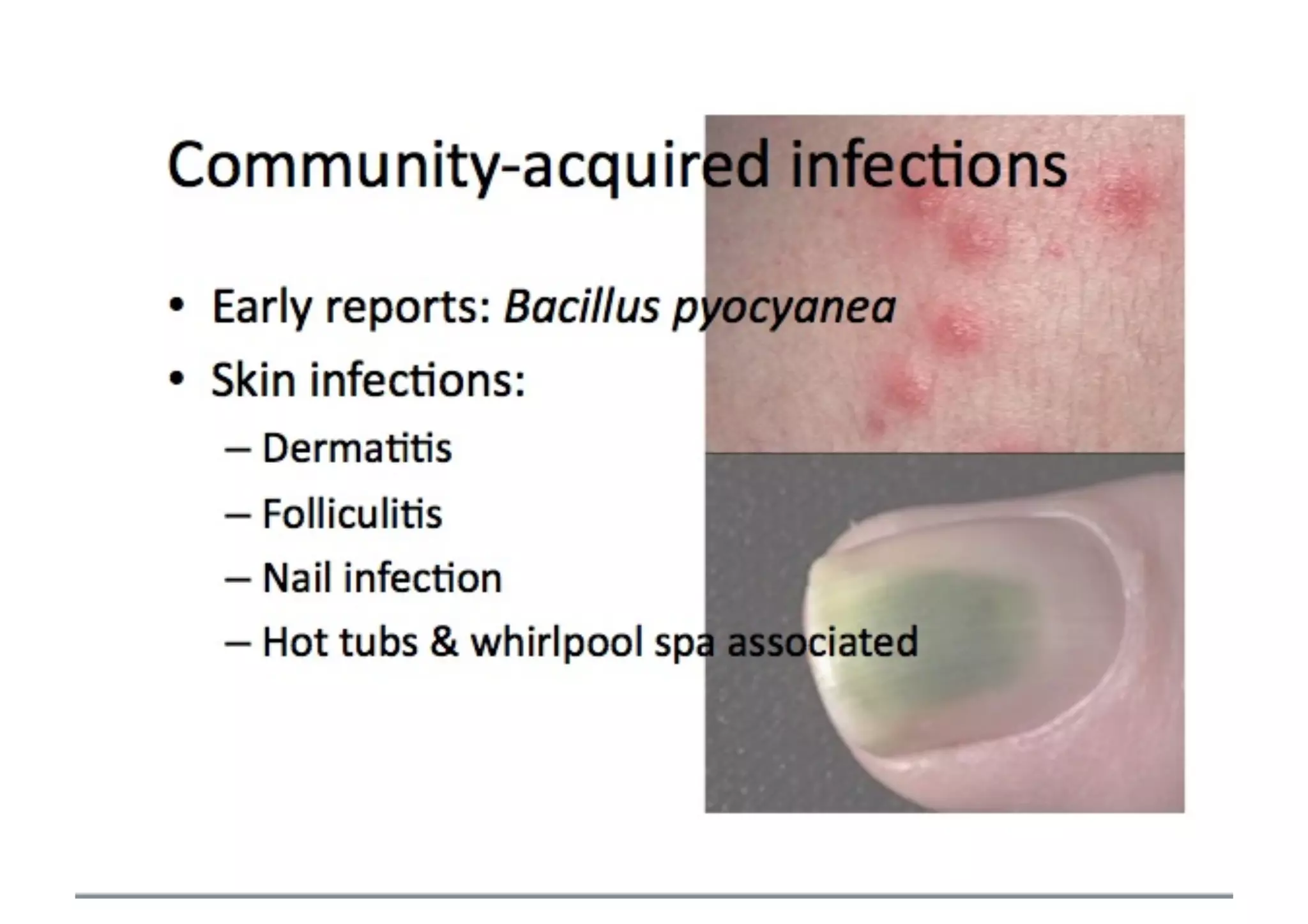 Pseudomonas folliculitis | PDF