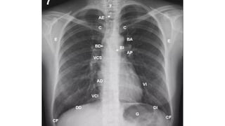Comprehensive Guide to Chest Radiography and Imaging Basics | PPTX