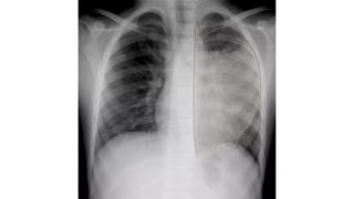 Comprehensive Guide to Chest Radiography and Imaging Basics | PPTX