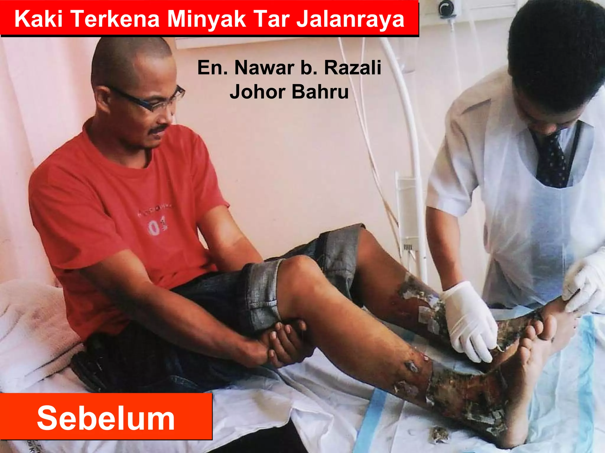 Sebelum Kaki Terkena Minyak Tar Jalanraya En. Nawar b. Razali Johor Bahru 
