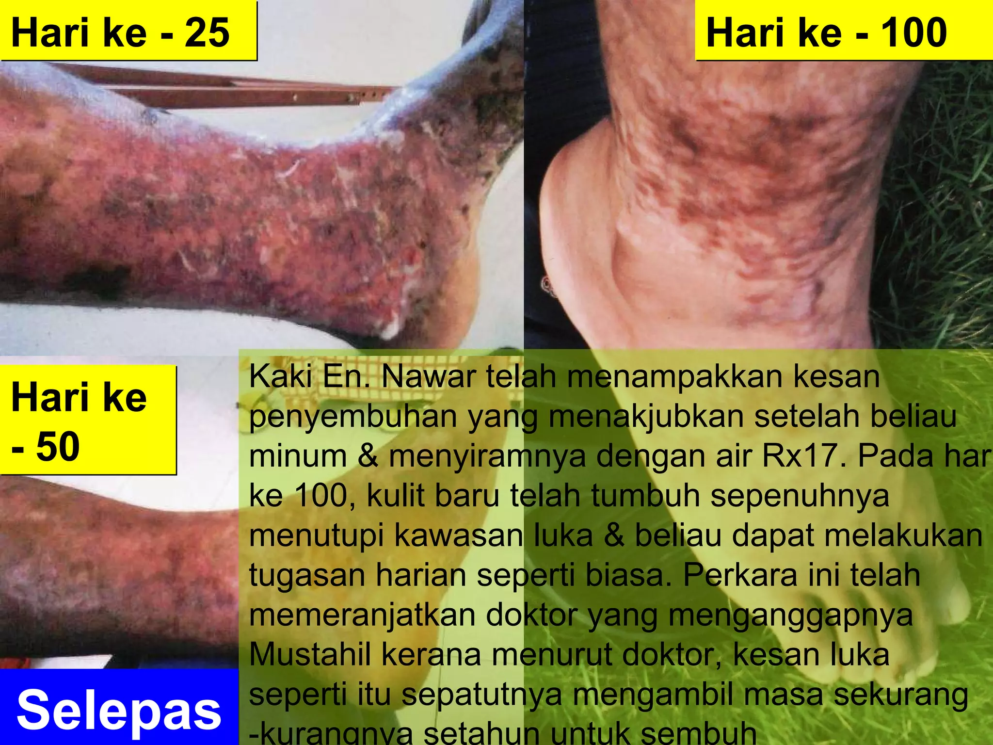 Selepas Hari ke - 25 Hari ke - 50 Hari ke - 100 Kaki En. Nawar telah menampakkan kesan  penyembuhan yang menakjubkan setelah beliau minum & menyiramnya dengan air Rx17. Pada hari ke 100, kulit baru telah tumbuh sepenuhnya  menutupi kawasan luka & beliau dapat melakukan tugasan harian seperti biasa. Perkara ini telah memeranjatkan doktor yang menganggapnya Mustahil kerana menurut doktor, kesan luka  seperti itu sepatutnya mengambil masa sekurang -kurangnya setahun untuk sembuh 