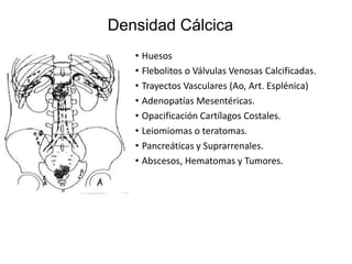 Densidad Cálcica
• Huesos
• Flebolitos o Válvulas Venosas Calcificadas.
• Trayectos Vasculares (Ao, Art. Esplénica)
• Adenopatías Mesentéricas.
• Opacificación Cartílagos Costales.
• Leiomiomas o teratomas.
• Pancreáticas y Suprarrenales.
• Abscesos, Hematomas y Tumores.

 