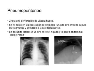 Pneumoperitoneo
• 2rio a una perforación de viscera hueca.
• En Rx Tórax en Bipedestación se ve media luna de aire entre la cúpula
diafragmática y el hígado o la cavidad gástrica.
• En decúbito lateral se ve aire entre el hígado y la pared abdominal.
¨Doble Pared¨

 