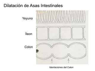 Dilatación de Asas Intestinales
Yeyuno

Íleon

Colon

Identaciones del Colon

 