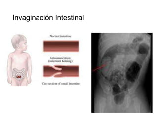 Invaginación Intestinal

 
