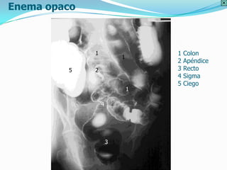 Enema opaco



              1                   1   Colon
                          1
                                  2   Apéndice
         5    2                   3   Recto
                                  4   Sigma
                                  5   Ciego
                              1

                  4




                      3
 