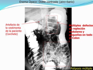 Enema Opaco: Doble contraste (aire+bario)




Artefacto de                                     Múltiples defectos
la vestimenta                                    de repleción
de la paciente                                   nodulares y
(Corchete)                                       pequeños en todo
                                                 el Colon




                                                  Poliposis múltiple
 