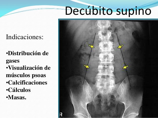 Rx abdomen a r