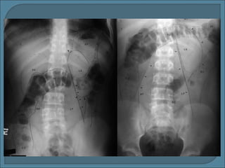 Rx abdomen wisha | PPT