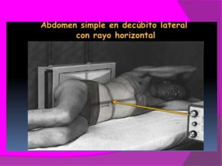 Rx de abdomen