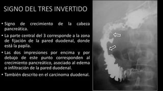 SIGNO DEL TRES INVERTIDO
• Signo de crecimiento de la cabeza
pancreática.
• La parte central del 3 corresponde a la zona
de fijación de la pared duodenal, donde
está la papila.
• Las dos impresiones por encima y por
debajo de este punto corresponden al
crecimiento pancreático, asociado al edema
o infiltración de la pared duodenal.
• También descrito en el carcinoma duodenal.
 