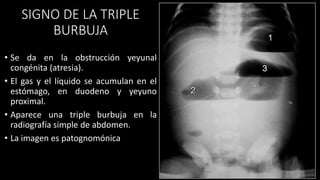 SIGNO DE LA TRIPLE
BURBUJA
• Se da en la obstrucción yeyunal
congénita (atresia).
• El gas y el líquido se acumulan en el
estómago, en duodeno y yeyuno
proximal.
• Aparece una triple burbuja en la
radiografía simple de abdomen.
• La imagen es patognomónica
 