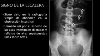 SIGNO DE LA ESCALERA
• Signo visto en la radiografía
simple de abdomen en la
obstrucción intestinal.
• Llamado así por el aspecto de
las asas intestinales dilatadas y
rellenas de aire, superpuestas
unas sobre otras.
 