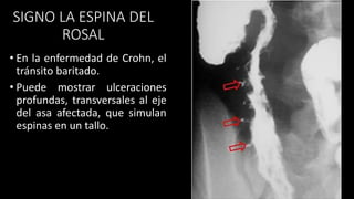 SIGNO LA ESPINA DEL
ROSAL
• En la enfermedad de Crohn, el
tránsito baritado.
• Puede mostrar ulceraciones
profundas, transversales al eje
del asa afectada, que simulan
espinas en un tallo.
 