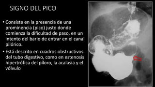 SIGNO DEL PICO
• Consiste en la presencia de una
prominencia (pico) justo donde
comienza la dificultad de paso, en un
intento del bario de entrar en el canal
pilórico.
• Está descrito en cuadros obstructivos
del tubo digestivo, como en estenosis
hipertrófica del píloro, la acalasia y el
vólvulo
 