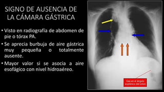 SIGNO DE AUSENCIA DE
LA CÁMARA GÁSTRICA
• Visto en radiografía de abdomen de
pie o tórax PA.
• Se aprecia burbuja de aire gástrica
muy pequeña o totalmente
ausente.
• Mayor valor si se asocia a aire
esofágico con nivel hidroaéreo.
 