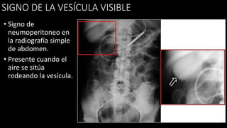 SIGNO DE LA VESÍCULA VISIBLE
• Signo de
neumoperitoneo en
la radiografía simple
de abdomen.
• Presente cuando el
aire se sitúa
rodeando la vesícula.
 