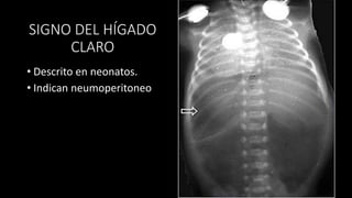 SIGNO DEL HÍGADO
CLARO
• Descrito en neonatos.
• Indican neumoperitoneo
 