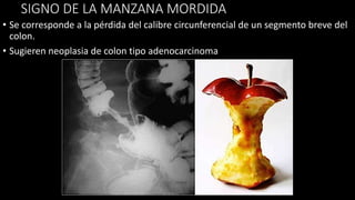 SIGNO DE LA MANZANA MORDIDA
• Se corresponde a la pérdida del calibre circunferencial de un segmento breve del
colon.
• Sugieren neoplasia de colon tipo adenocarcinoma
 