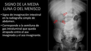 SIGNO DE LA MEDIA
LUNA O DEL MENISCO
• Signo de invaginación intestinal
en la radiografía simple de
abdomen.
• Corresponde a la semiluna de
gas intraluminal que queda
atrapado entre el asa
invaginada y el asa invaginante.
 