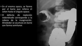• En el enema opaco, se forma
por el bario que rellena el
colon hasta el ángulo opaco.
• El defecto de repleción
redondeado corresponde a la
cabeza de la invaginación.
Alrededor se acumula en bario
con forma semilunar.
 