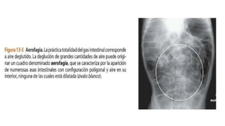 Rx de abdomen simple en decúbito, bipedestación, tangencial, patrón normal de gases intestinales, niveles líquidos normales